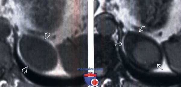 МРТ при смешанной опухоли надпочечника