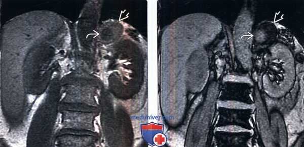 МРТ при смешанной опухоли надпочечника