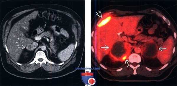 КТ, МРТ, ПЭТ, УЗИ при метастазах в надпочечники