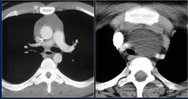 Картинки по запросу МРТ вилочковой железы