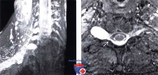 КТ, МРТ травматического разрыва твердой мозговой оболочки