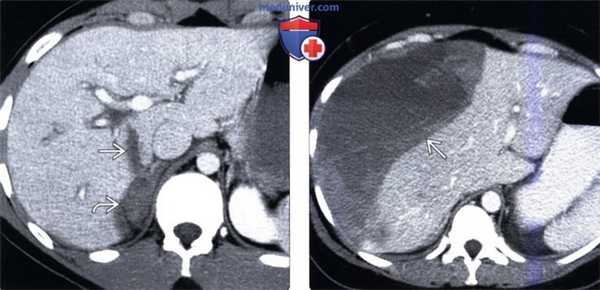 КТ, МРТ, УЗИ признаки травматического повреждения печени