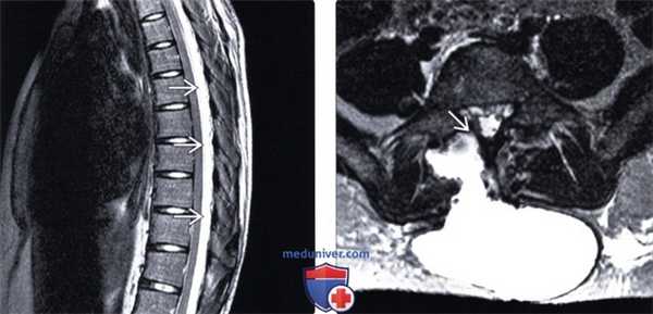 КТ, МРТ травматического разрыва твердой мозговой оболочки