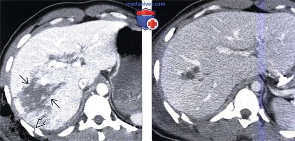 КТ, МРТ, УЗИ признаки травматического повреждения печени