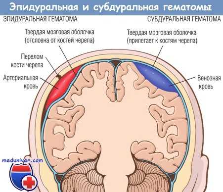 Эпидуральная и субдуральная гематомы