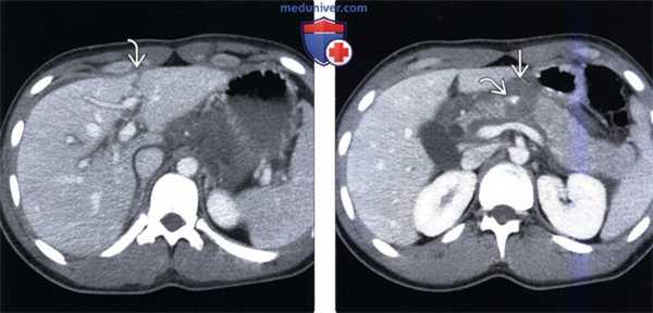 КТ, МРТ, УЗИ признаки травматического повреждения печени