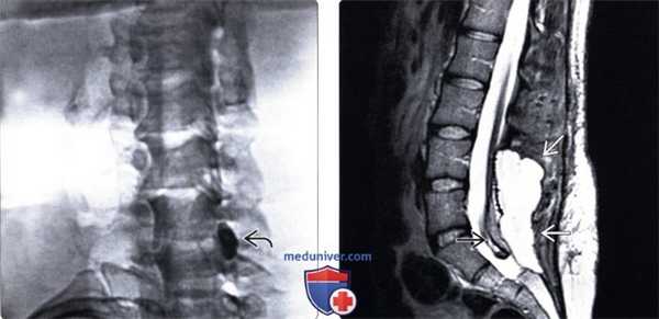 КТ, МРТ травматического разрыва твердой мозговой оболочки