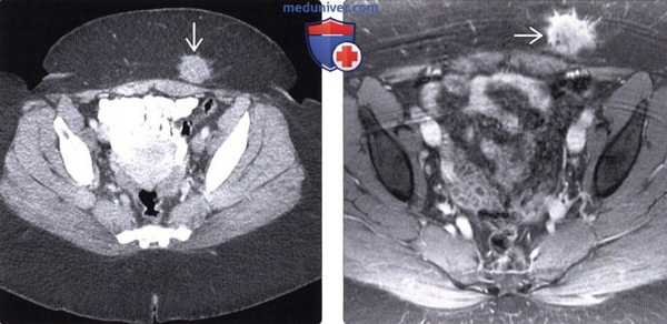 КТ при патологии в местах выполнения разрезов и инъекций
