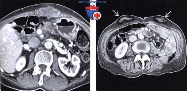 КТ при патологии в местах выполнения разрезов и инъекций