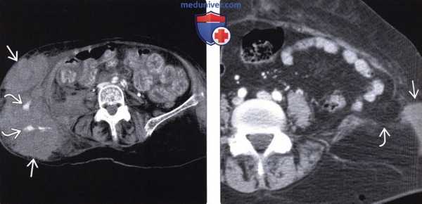 Лучевая диагностика травматической грыжи брюшной стенки