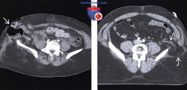 Лучевая диагностика травматической грыжи брюшной стенки