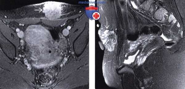 КТ при патологии в местах выполнения разрезов и инъекций