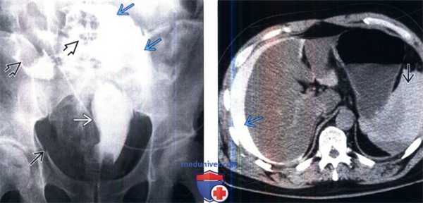 КТ, цистография при травме мочевого пузыря