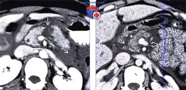 ЭРХПГ, КТ, МРТ, УЗИ при травме поджелудочной железы