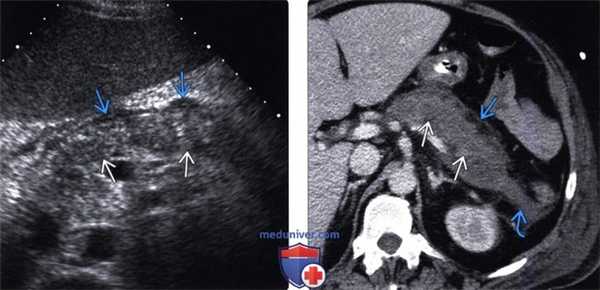 УЗИ, КТ при остром панкреатите