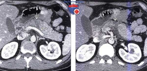 ЭРХПГ, КТ, МРТ, УЗИ при травме поджелудочной железы