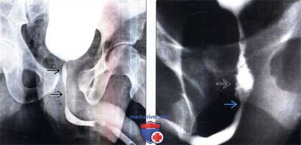 Уретрография при травме уретры