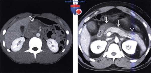 ЭРХПГ, КТ, МРТ, УЗИ при травме поджелудочной железы