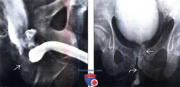 Уретрография при травме уретры