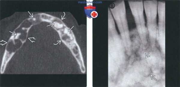 Рентгенограмма, КТ при цветущей костной дисплазии челюсти