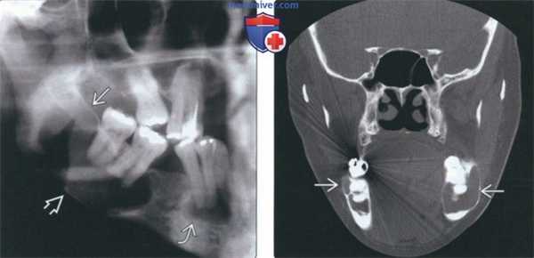 Рентгенограмма, КТ при цветущей костной дисплазии челюсти