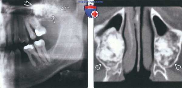 Рентгенограмма, КТ при цветущей костной дисплазии челюсти