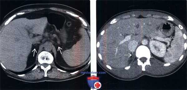 КТ при надпочечниковой недостаточности