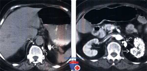 КТ при туберкулезе и грибковой инфекции надпочечников
