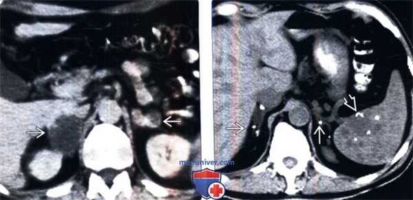 КТ при туберкулезе и грибковой инфекции надпочечников