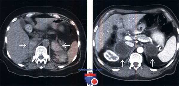 КТ при надпочечниковой недостаточности