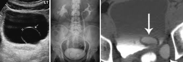 Уретероцеле на УЗИ, экскреторной урографии и КТ с контрастом [17]