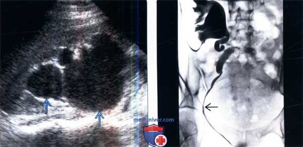 МРТ, УЗИ, пиелография при уретерэктазии беременных