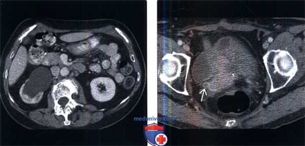 КТ, пиелография при переходноклеточном раке мочеточника