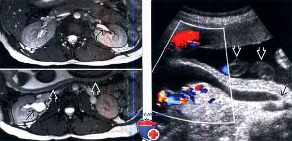 МРТ, УЗИ, пиелография при уретерэктазии беременных