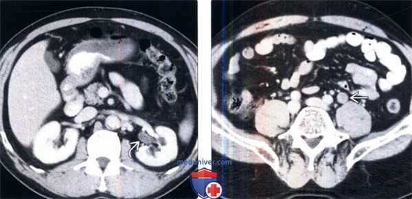 КТ, пиелография при переходноклеточном раке мочеточника
