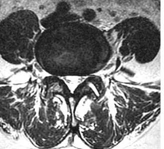 остеоартрит