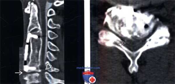 МРТ при ускоренной дегенерации позвоночника