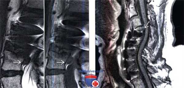 МРТ при ускоренной дегенерации позвоночника