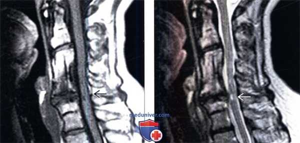 МРТ при ускоренной дегенерации позвоночника