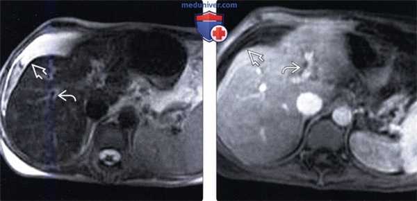 Дифференциальная диагностика веноокклюзионной болезни печени (ВБП)