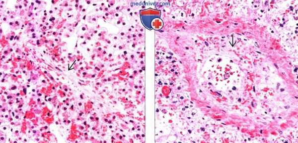 Дифференциальная диагностика веноокклюзионной болезни печени (ВБП)