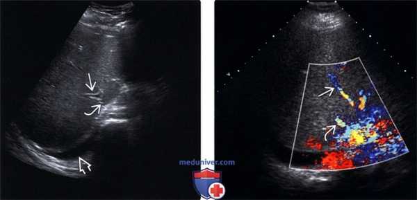 УЗИ печени при веноокклюзионной болезни (ВОБ)