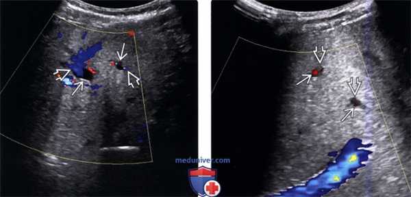 УЗИ печени при болезни Кароли