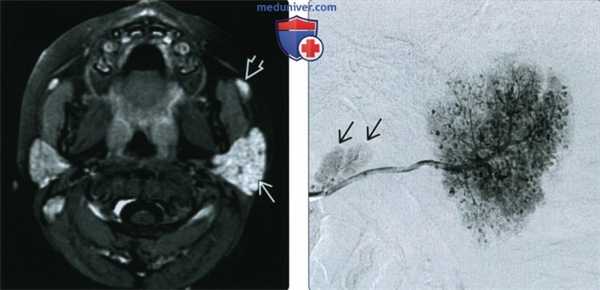 КТ, МРТ, УЗИ при остром паротите