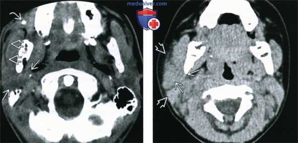 КТ, МРТ, УЗИ при остром паротите