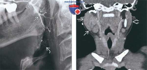 Лучевая диагностика воспаления околоушной железы