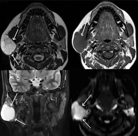 КТ аденомы слюнной железы [14]