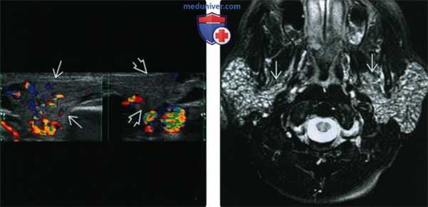 КТ, МРТ, УЗИ при остром паротите