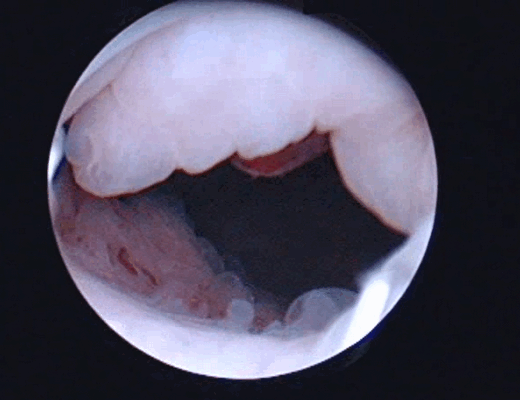 Цистоскопическое обследование пациента С. Цистоскопическая картина солидного образования, вдающегося в полость мочевого пузыря в виде массивных бугристых масс, покрытых отечной слизистой оболочкой