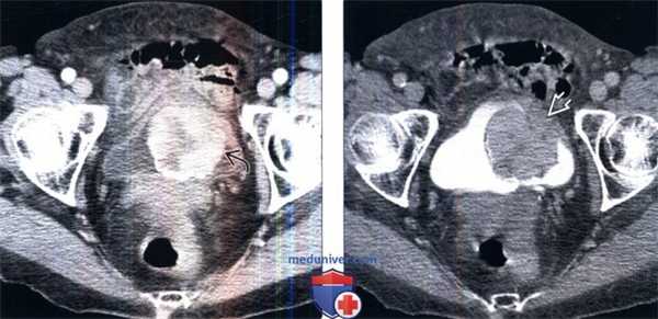 КТ при воспалительной псевдоопухоли мочевого пузыря